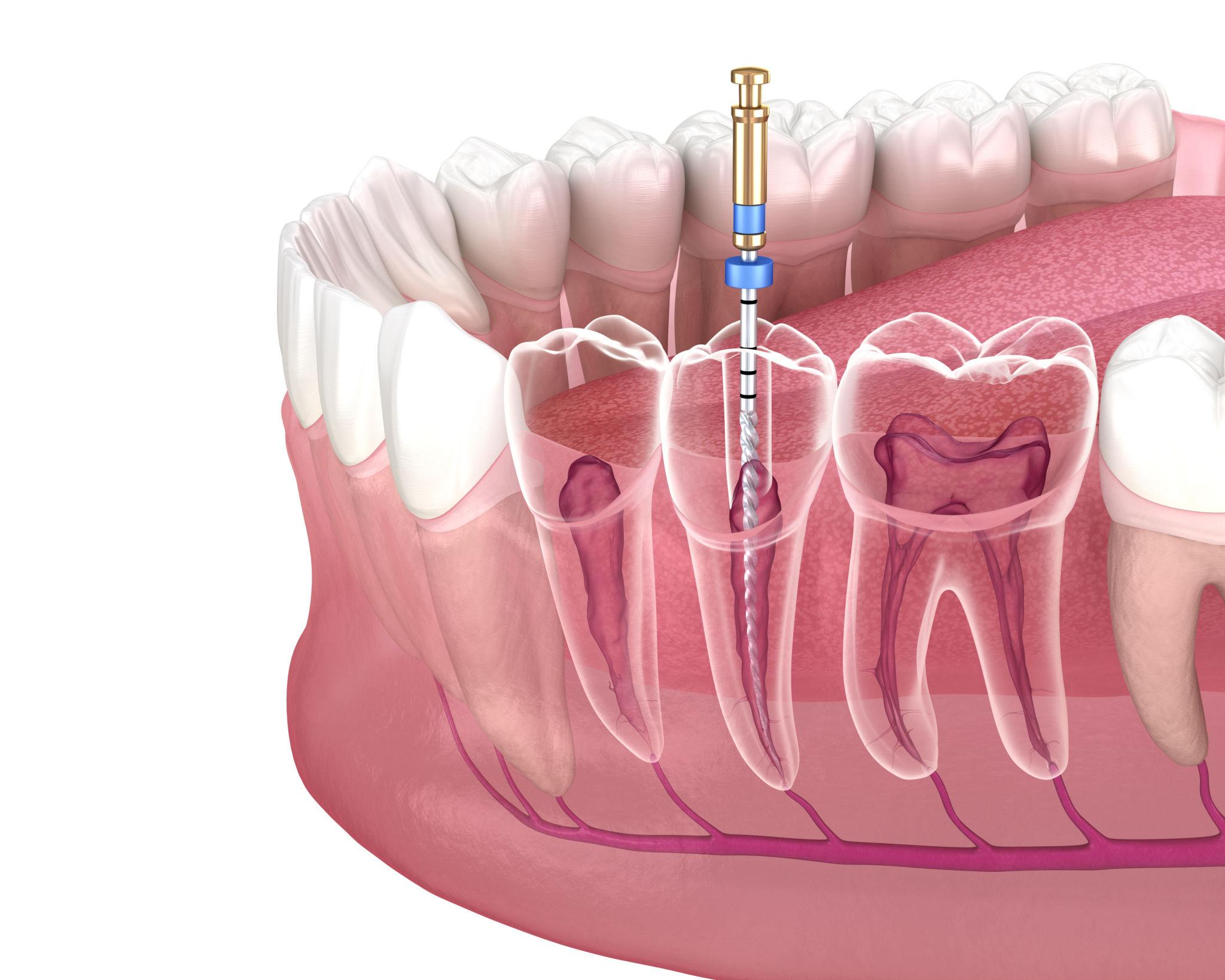 Root Canal Treatment in Mira Road