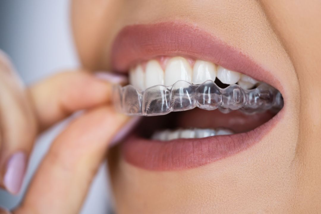 Clear Aligners Treatment in Mira Road