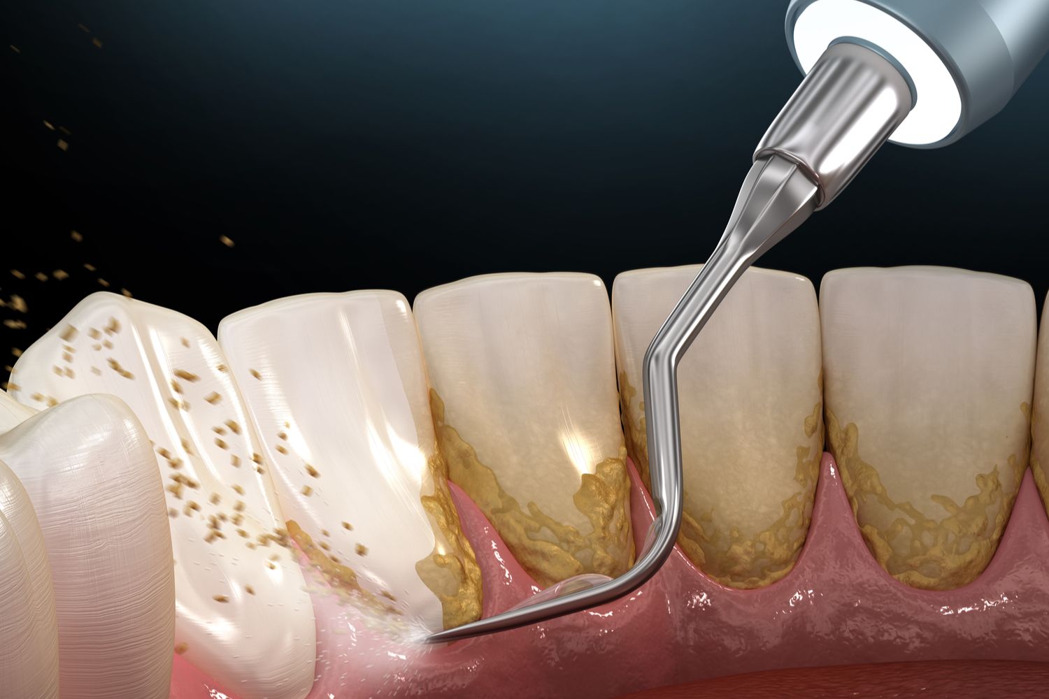 Professional Teeth Cleaning in Mira Road