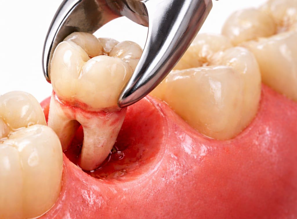 Tooth Extraction Treatment in Mira Road