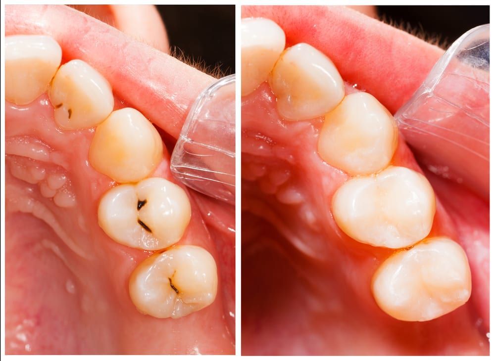 Tooth Filling Treatment in Mira Road