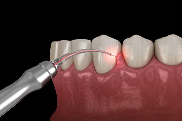Gum Treatment in Mira Road