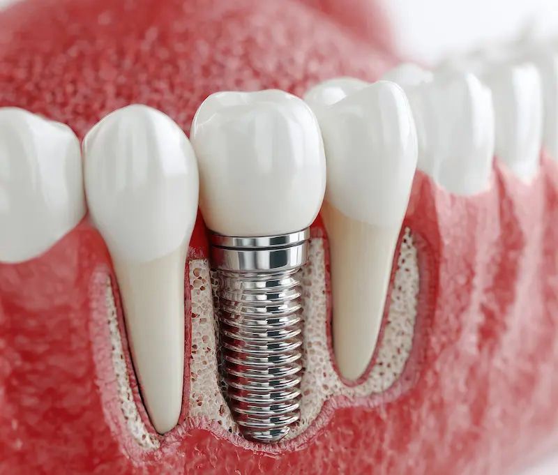 Dental Implants in Mira Road