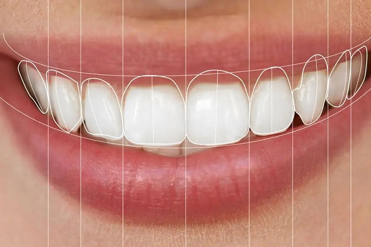 Smile Designing in Mira Road