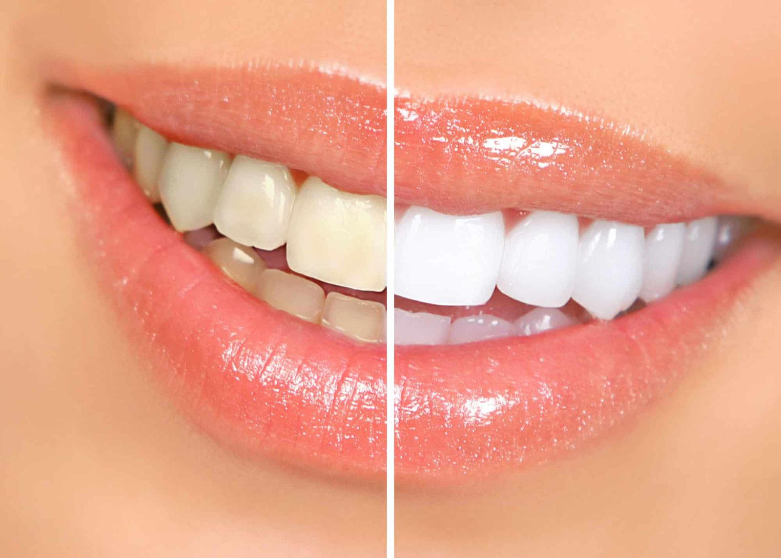 Teeth Whitening Treatment in Mira Road