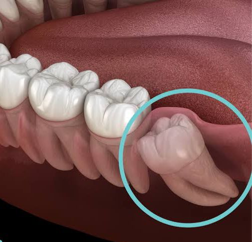 Wisdom Tooth Removal in Mira Road